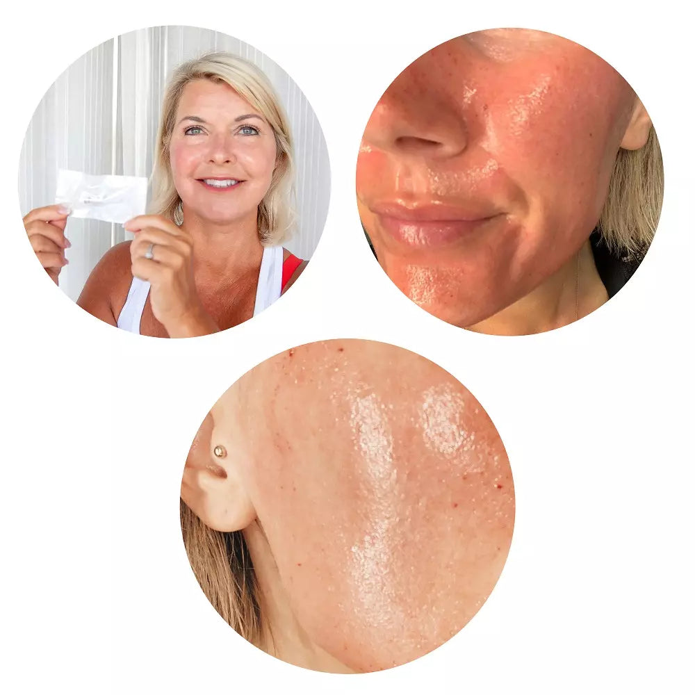TrendRehab - MicroneedlingPen